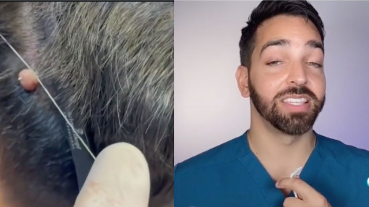 <p>TikTok trend mole removal</p>
