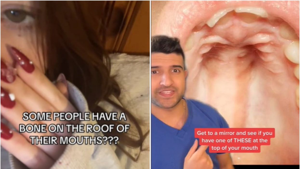 People are just discovering that they might have a bony growth in the mouth