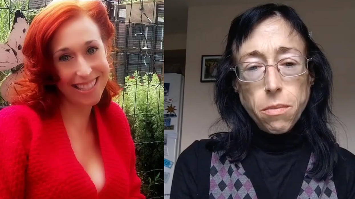 TikToker who documented battle to raise £200,000 for Anorexia treatment has died