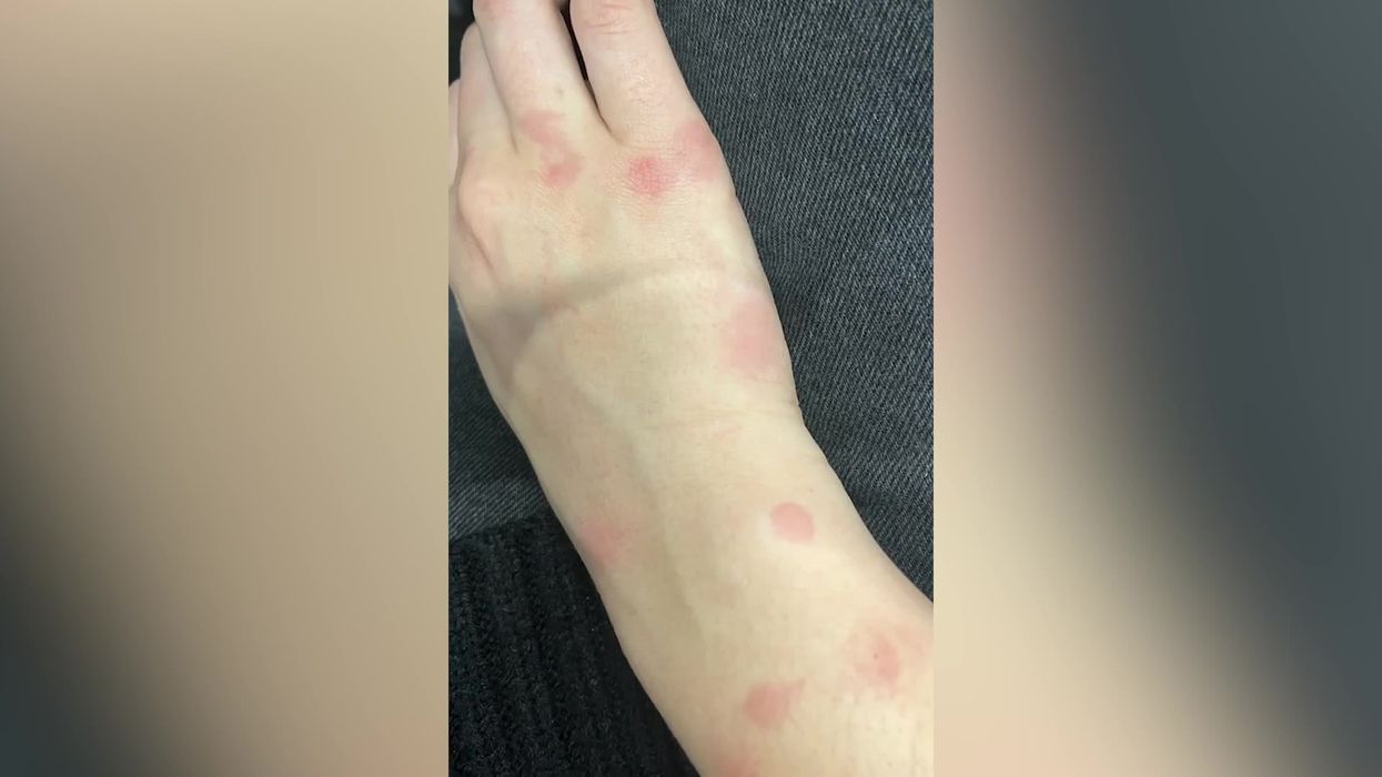 Travel vlogger documents finding bedbugs in Paris Airbnb indy100