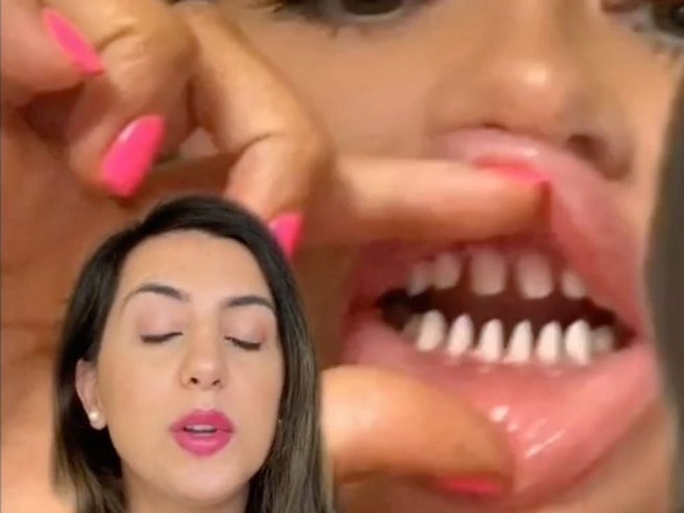 Veneers and crowns are completely different and many people are getting it wrong.