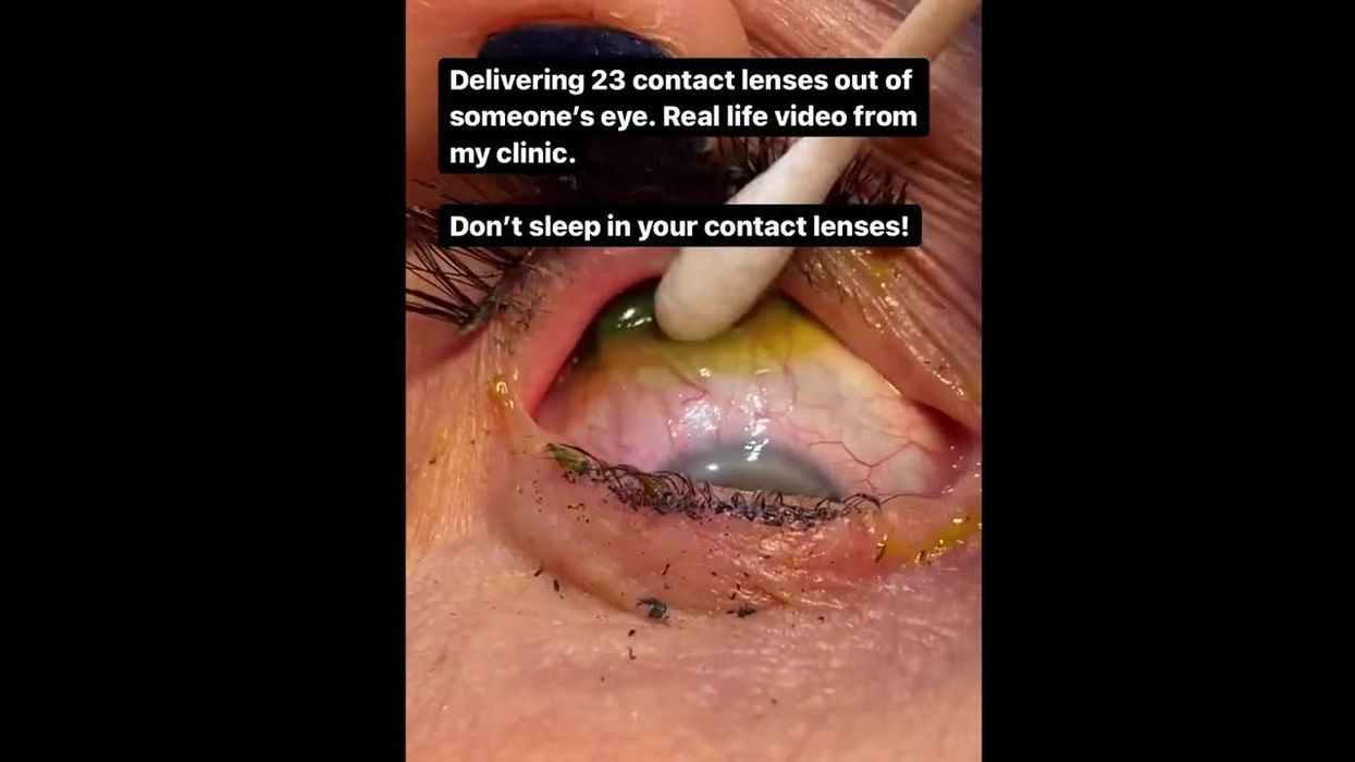 Gruesome clip sees doctor remove 23 contacts from forgetful woman’s eye