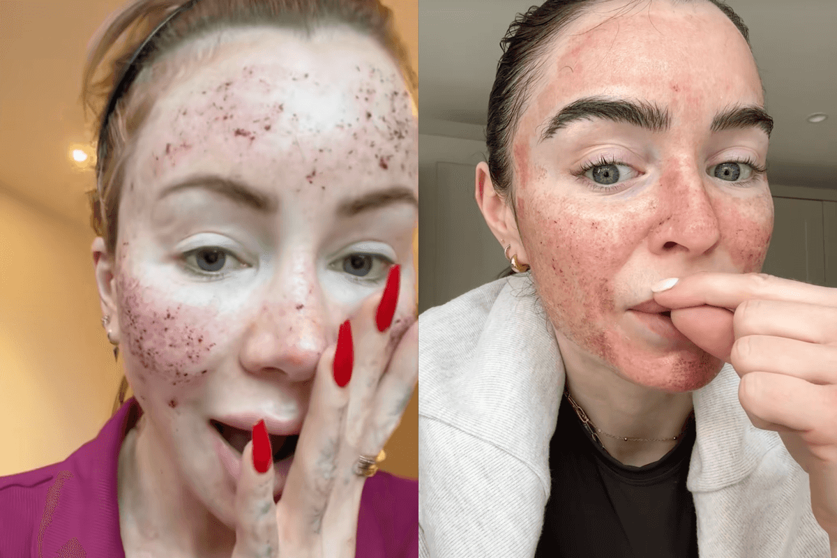 No, your favourite celebrities aren't 'burning' their skin off - here's what to know about CO2 laser