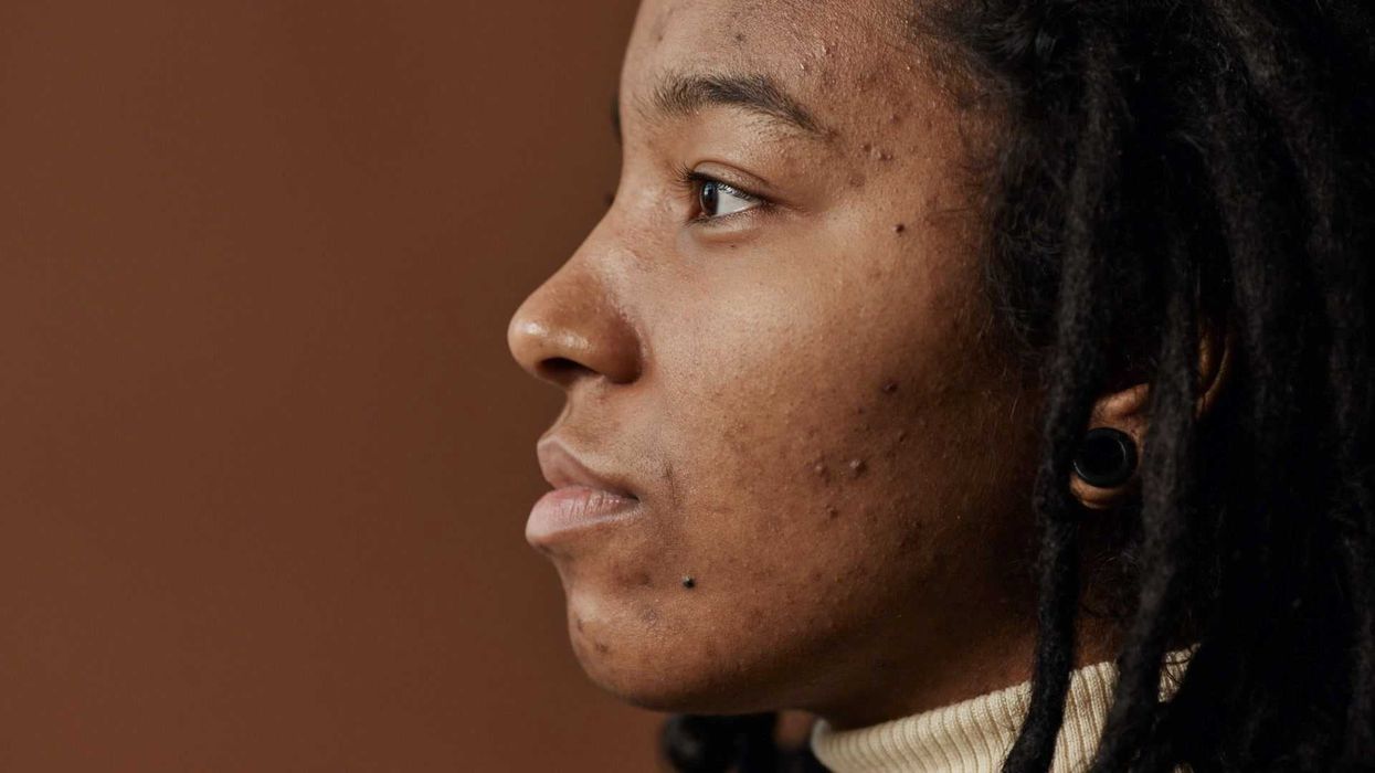 Why you should never pop a pimple in the 'triangle of death' on your face