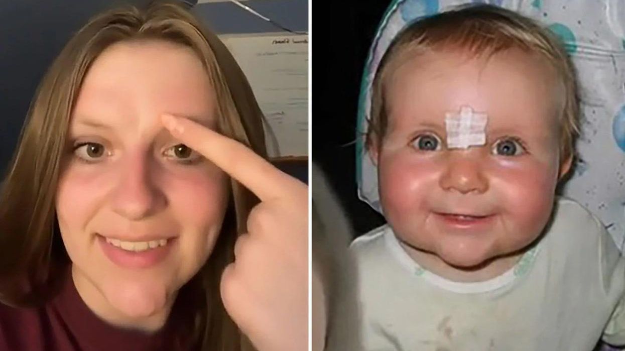 TikToker claims forehead scar caused by 'eating' her twin in the womb