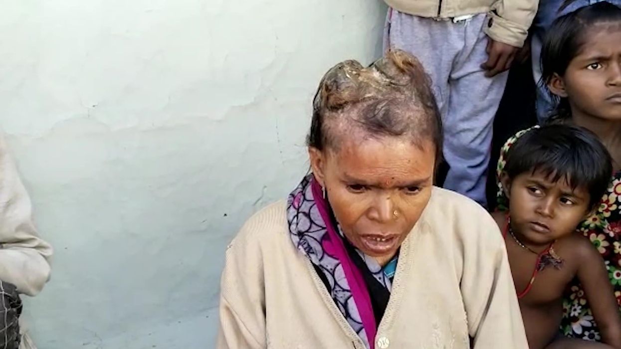 Woman leaves doctors stunned after growing horns from her head
