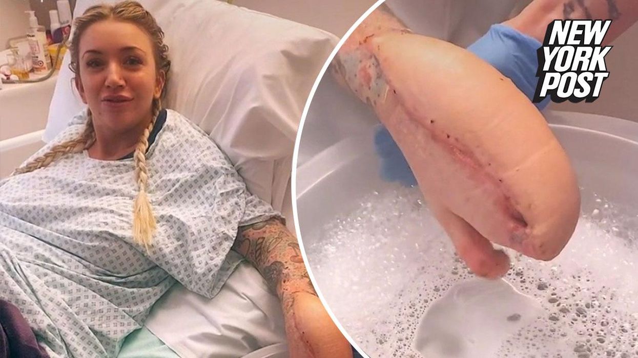Woman left with 'shark hand' after doctors sewed it up inside her