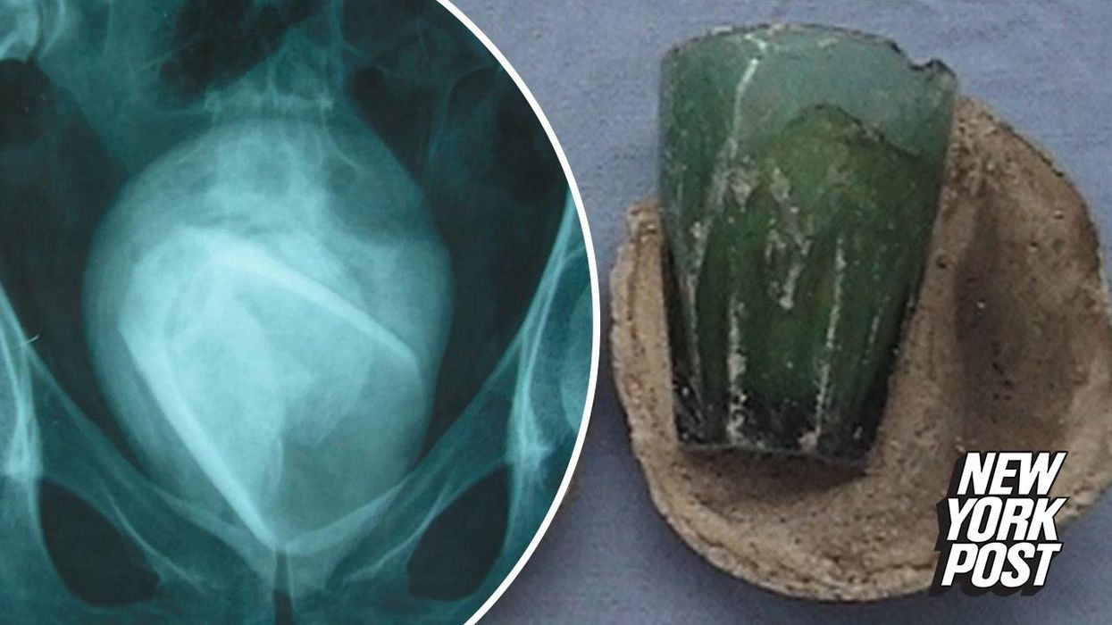 Woman's UTI was actually a glass stuck inside of her for 4 years