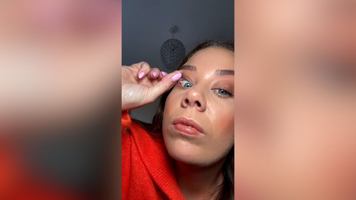 Woman shares shocking moment she pops giant spot under eyelid