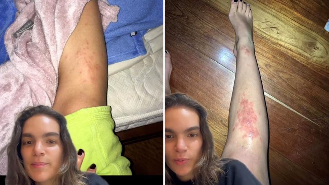 Doctor warns against sleeping habit which can cause parasitic eye infections