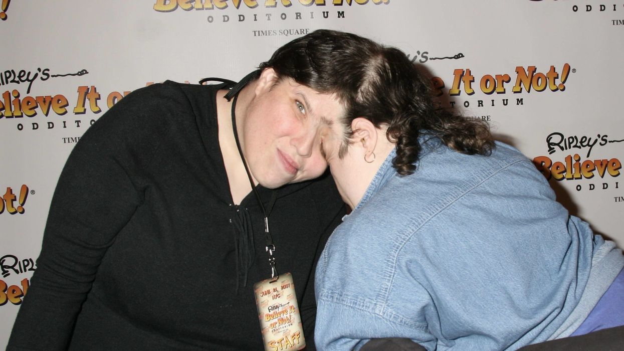 Conjoined twin forced to stay attached to her sister's body for days after she died